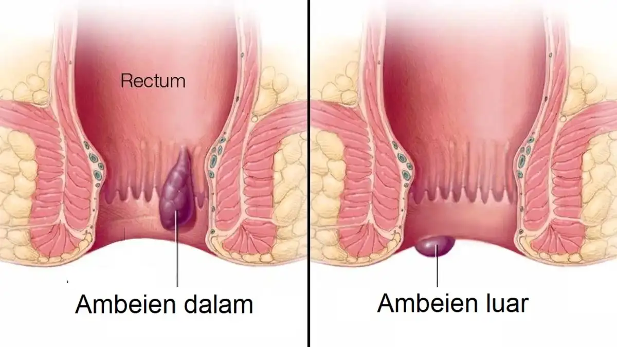 ambeien luar