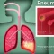 apa itu pneumonia