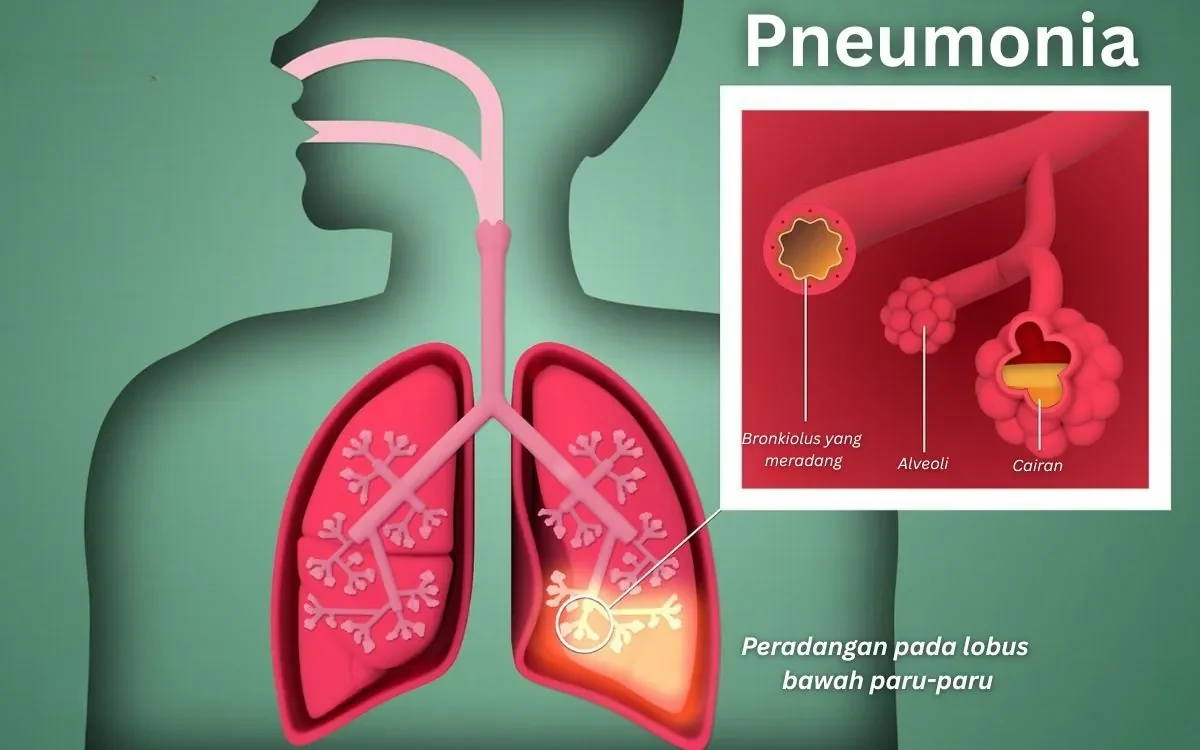 apa itu pneumonia