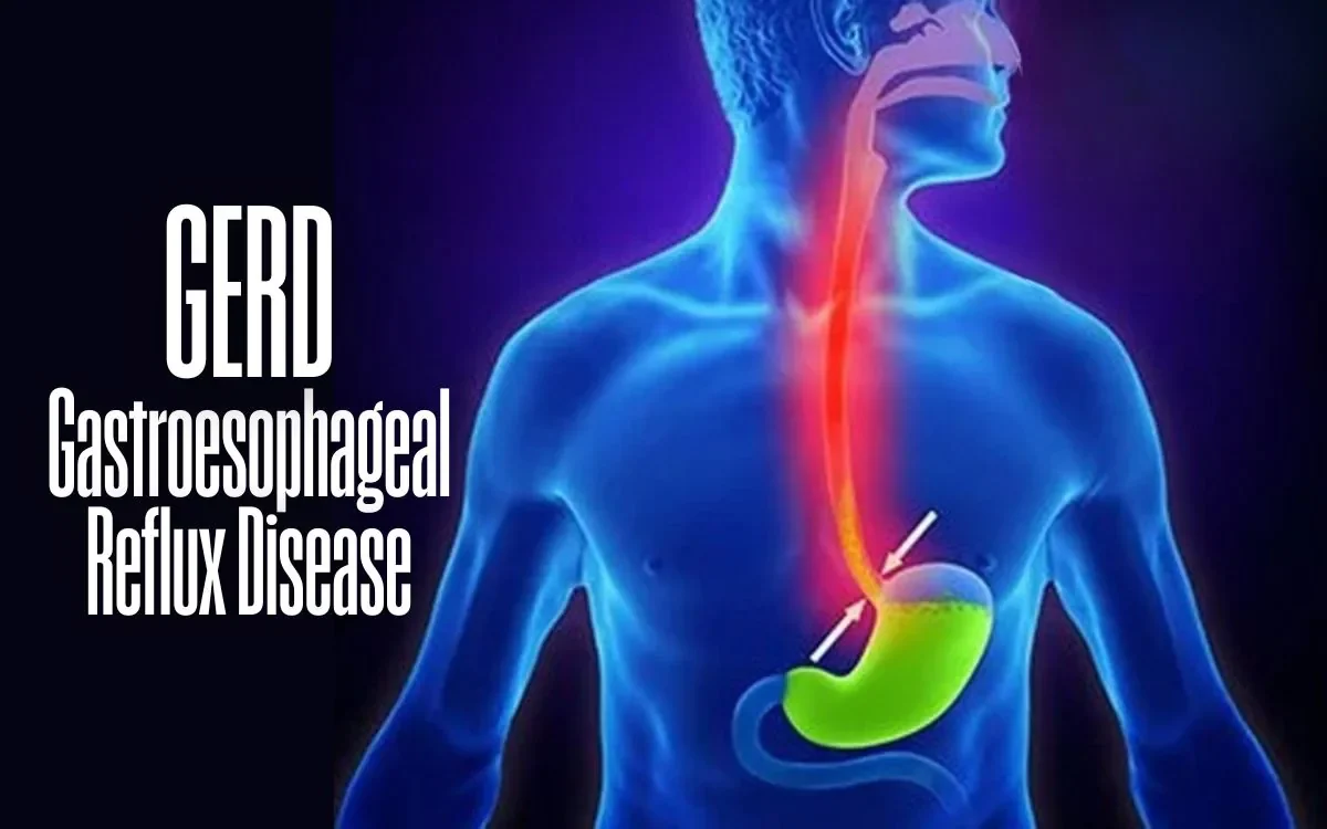 gerd adalah