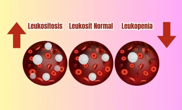 leukosit tinggi