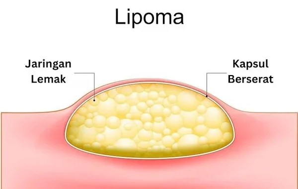 lipoma