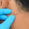 lipoma adalah