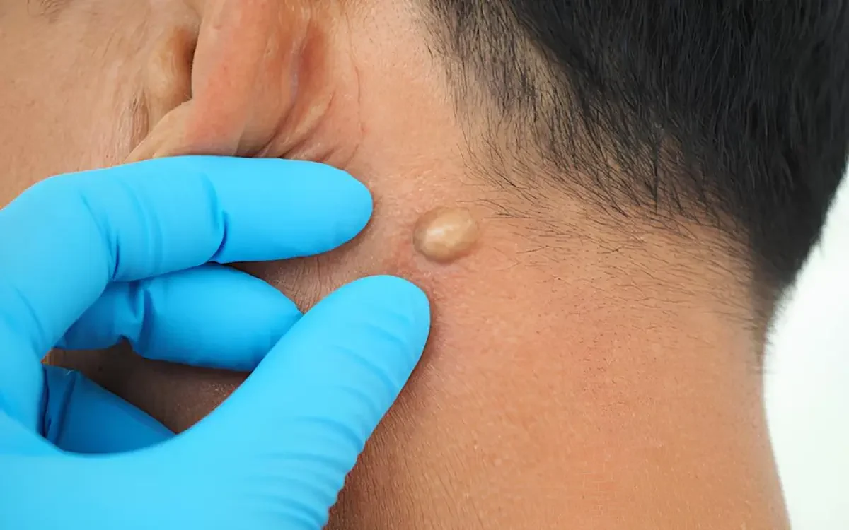 lipoma adalah