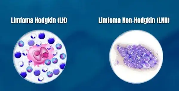 kanker limfoma