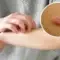 limfoma adalah