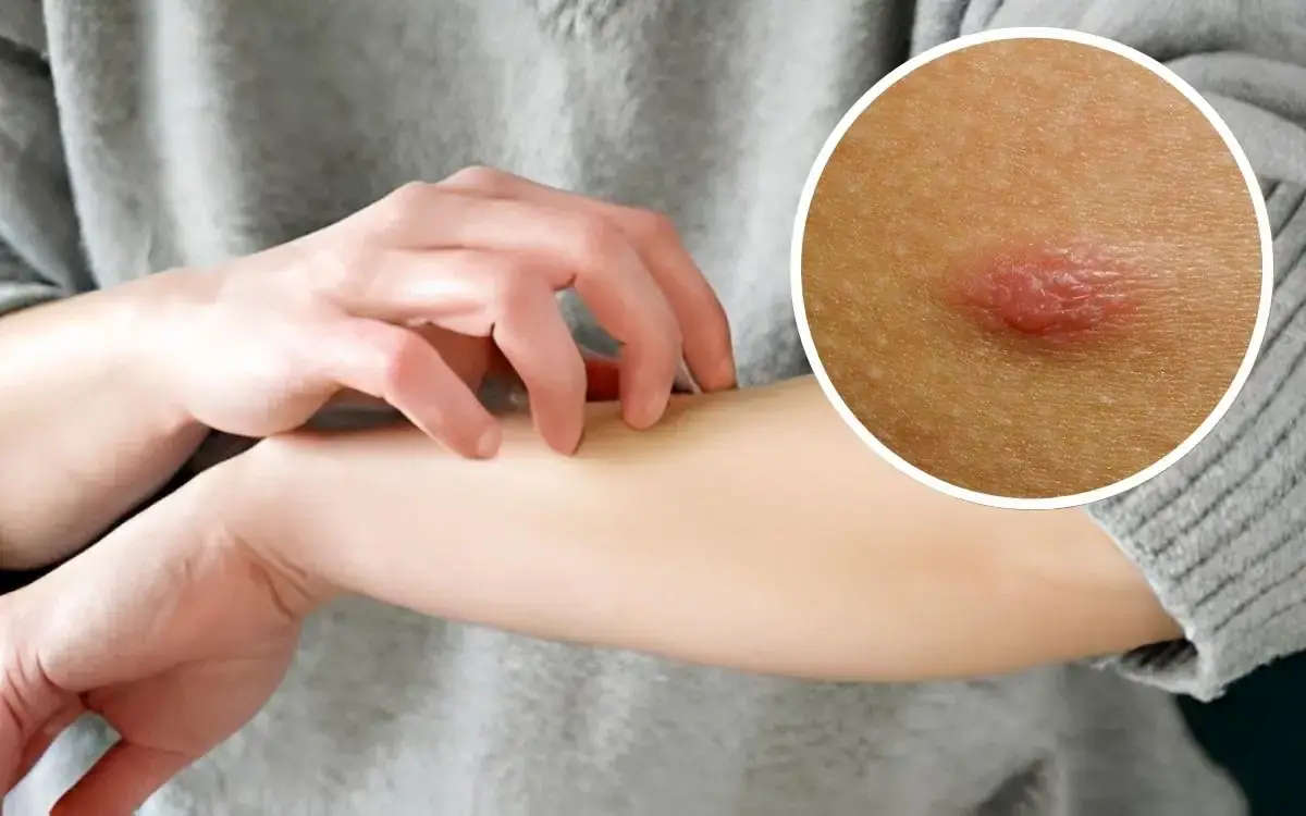 limfoma adalah