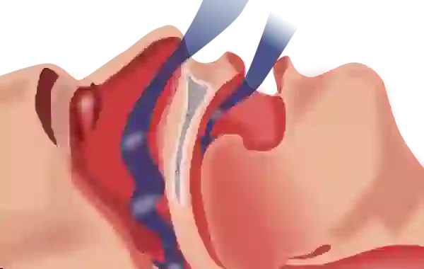 apa itu sleep apnea